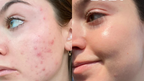 Aevinta serum results - skin brightening and dark spot reduction Pakistan