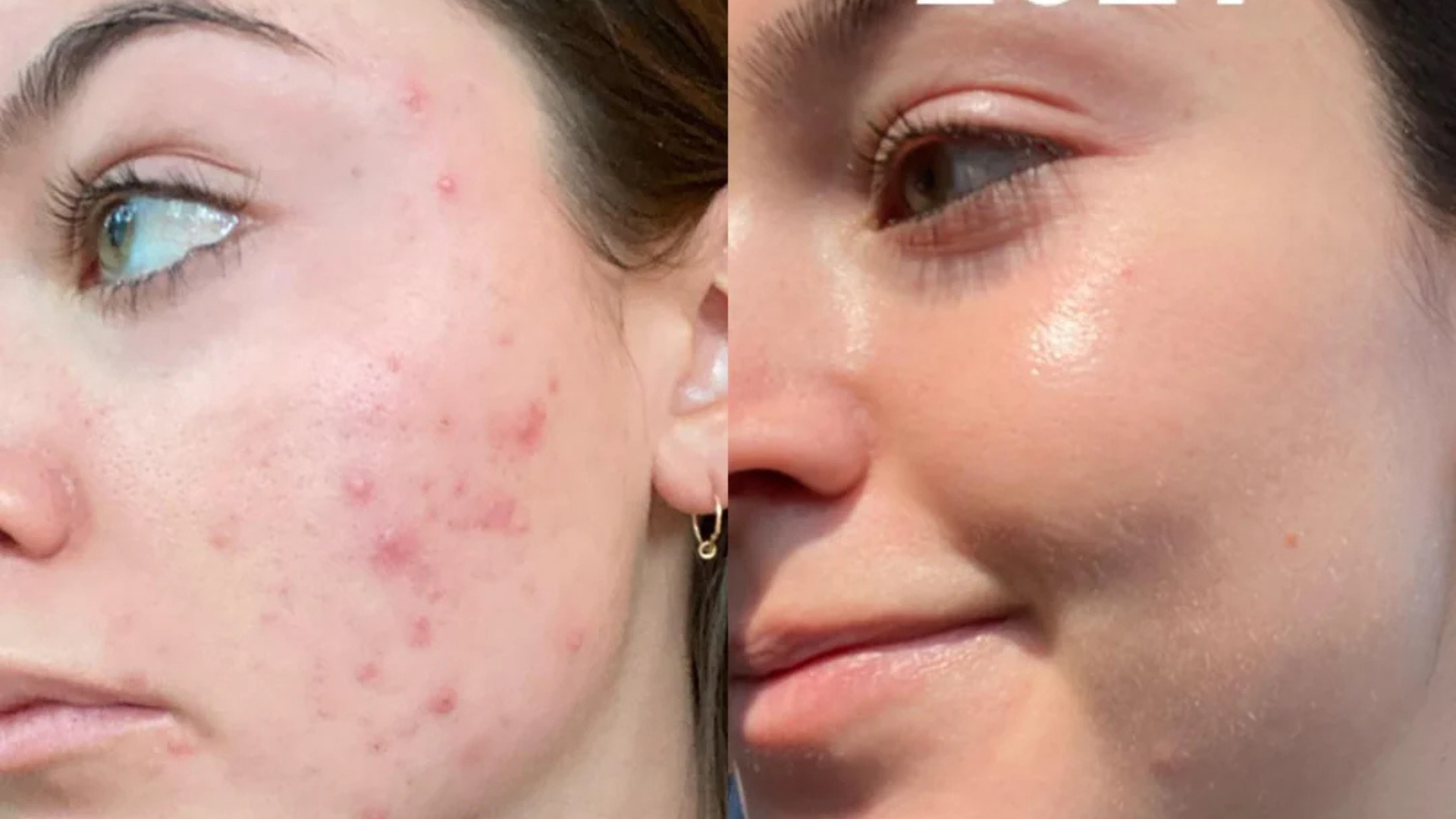 Aevinta serum results - skin brightening and dark spot reduction Pakistan